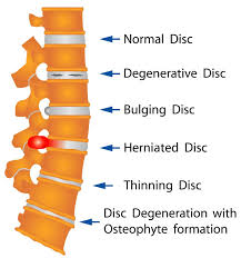 Sciatic Pain Relief - Mike Gillis RMT - Moncton Massage Therapy