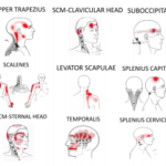 Headache Trigger Point Patterns